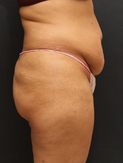 Tummy Tuck Case 6865, Before Treatment, Female Patient, Set 3
