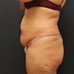 Tummy Tuck Case 6865, Before Treatment, Female Patient, Thumbnail 4