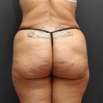 Tummy Tuck Case 6865, After Treatment, Female Patient, Thumbnail 6