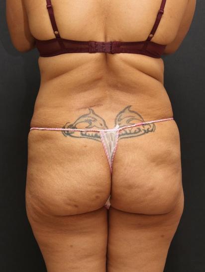 Tummy Tuck Case 6865, Before Treatment, Female Patient, Set 6
