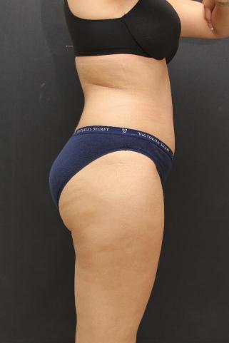 Tummy Tuck Case 6867, After Treatment, Female Patient, Set 5