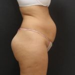 Tummy Tuck Case 6867, Before Treatment, Female Patient, Thumbnail 5