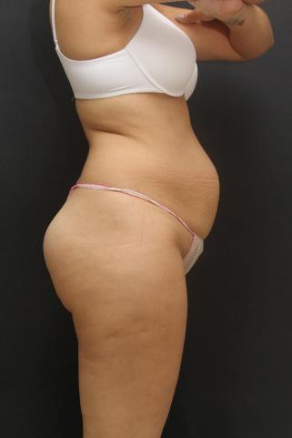 Tummy Tuck Case 6867, Before Treatment, Female Patient, Set 5