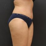 Tummy Tuck Case 6867, After Treatment, Female Patient, Thumbnail 4