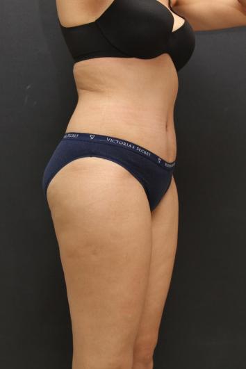 Tummy Tuck Case 6867, After Treatment, Female Patient, Set 4