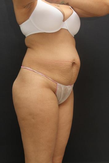 Tummy Tuck Case 6867, Before Treatment, Female Patient, Set 4