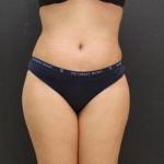 Tummy Tuck Case 6867, After Treatment, Female Patient, Thumbnail 1