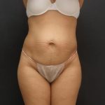 Tummy Tuck Case 6867, Before Treatment, Female Patient, Thumbnail 1