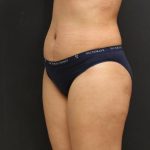 Tummy Tuck Case 6867, After Treatment, Female Patient, Thumbnail 2