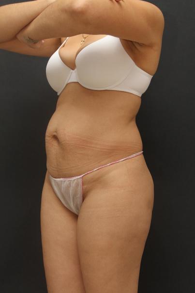 Tummy Tuck Case 6867, Before Treatment, Female Patient, Set 2