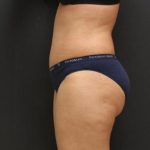 Tummy Tuck Case 6867, After Treatment, Female Patient, Thumbnail 3