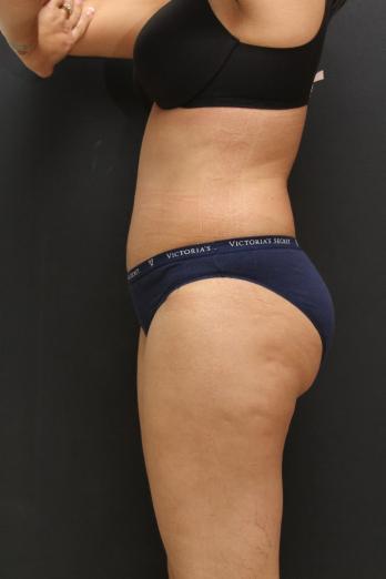 Tummy Tuck Case 6867, After Treatment, Female Patient, Set 3