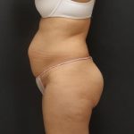 Tummy Tuck Case 6867, Before Treatment, Female Patient, Thumbnail 3