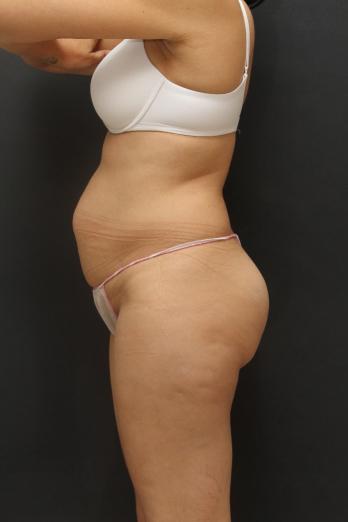 Tummy Tuck Case 6867, Before Treatment, Female Patient, Set 3