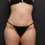 Tummy Tuck Case 6868, After Treatment, Female Patient, Thumbnail 1