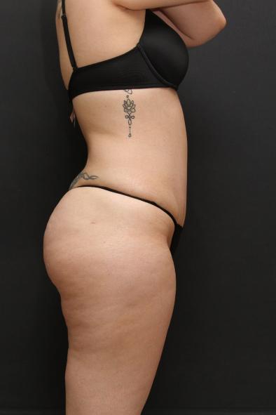 Tummy Tuck Case 6868, After Treatment, Female Patient, Set 3