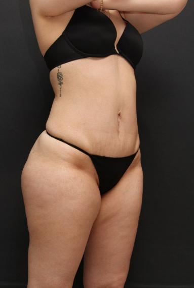 Tummy Tuck Case 6868, After Treatment, Female Patient, Set 2