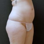 Tummy Tuck Case 6868, Before Treatment, Female Patient, Thumbnail 2