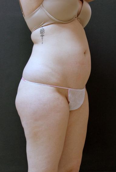 Tummy Tuck Case 6868, Before Treatment, Female Patient, Set 2