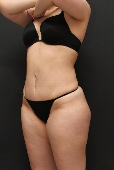 Tummy Tuck Case 6868, After Treatment, Female Patient, Set 4
