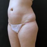 Tummy Tuck Case 6868, Before Treatment, Female Patient, Thumbnail 4