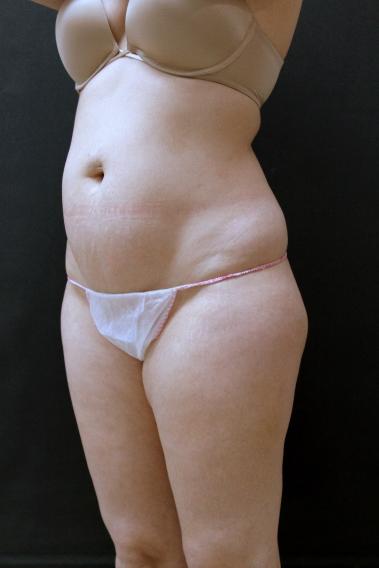 Tummy Tuck Case 6868, Before Treatment, Female Patient, Set 4