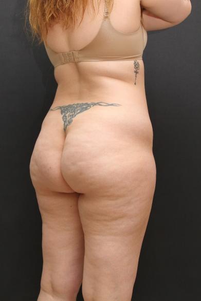 Tummy Tuck Case 6868, Before Treatment, Female Patient, Set 7