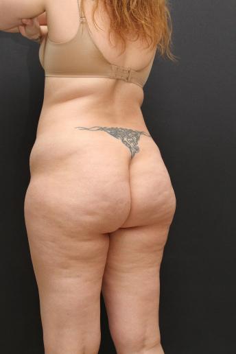 Tummy Tuck Case 6868, Before Treatment, Female Patient, Set 5