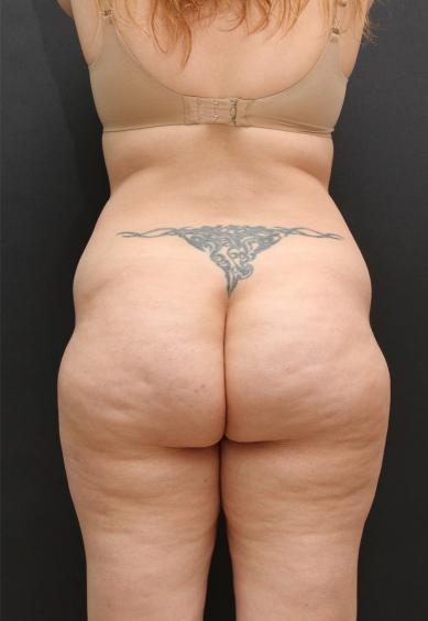 Tummy Tuck Case 6868, Before Treatment, Female Patient, Set 6