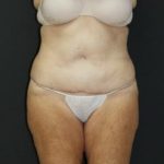 Tummy Tuck Case 6869, After Treatment, Female Patient, Thumbnail 1