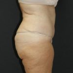 Tummy Tuck Case 6869, After Treatment, Female Patient, Thumbnail 3