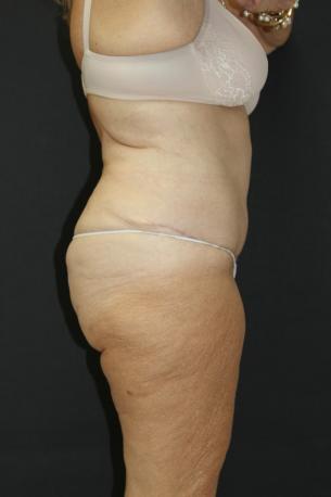 Tummy Tuck Case 6869, After Treatment, Female Patient, Set 3