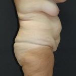 Tummy Tuck Case 6869, Before Treatment, Female Patient, Thumbnail 3