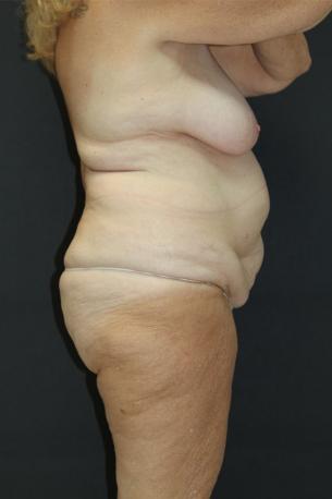 Tummy Tuck Case 6869, Before Treatment, Female Patient, Set 3