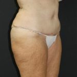 Tummy Tuck Case 6869, After Treatment, Female Patient, Thumbnail 2