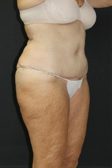 Tummy Tuck Case 6869, After Treatment, Female Patient, Set 2