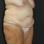 Tummy Tuck Case 6869, Before Treatment, Female Patient, Thumbnail 2