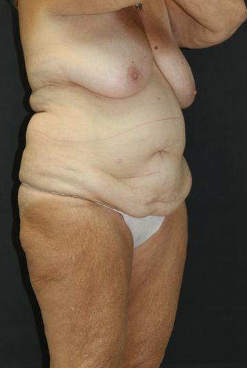 Tummy Tuck Case 6869, Before Treatment, Female Patient, Set 2