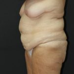 Tummy Tuck Case 6869, Before Treatment, Female Patient, Thumbnail 4