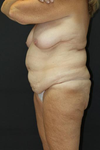 Tummy Tuck Case 6869, Before Treatment, Female Patient, Set 4