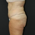 Tummy Tuck Case 6869, After Treatment, Female Patient, Thumbnail 5