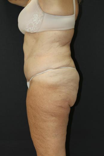 Tummy Tuck Case 6869, After Treatment, Female Patient, Set 5