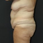 Tummy Tuck Case 6869, Before Treatment, Female Patient, Thumbnail 5