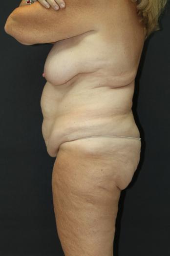 Tummy Tuck Case 6869, Before Treatment, Female Patient, Set 5