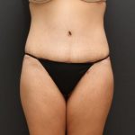 Tummy Tuck Case 6870, After Treatment, Female Patient, Thumbnail 1