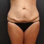Tummy Tuck Case 6870, Before Treatment, Female Patient, Thumbnail 1