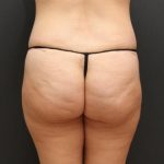 Tummy Tuck Case 6870, After Treatment, Female Patient, Thumbnail 8