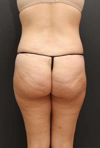 Tummy Tuck Case 6870, After Treatment, Female Patient, Set 8