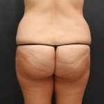 Tummy Tuck Case 6870, Before Treatment, Female Patient, Thumbnail 8