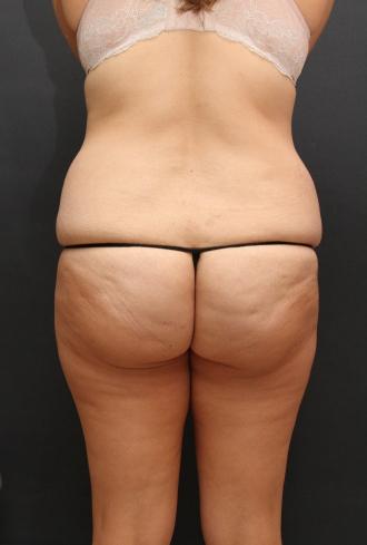 Tummy Tuck Case 6870, Before Treatment, Female Patient, Set 8